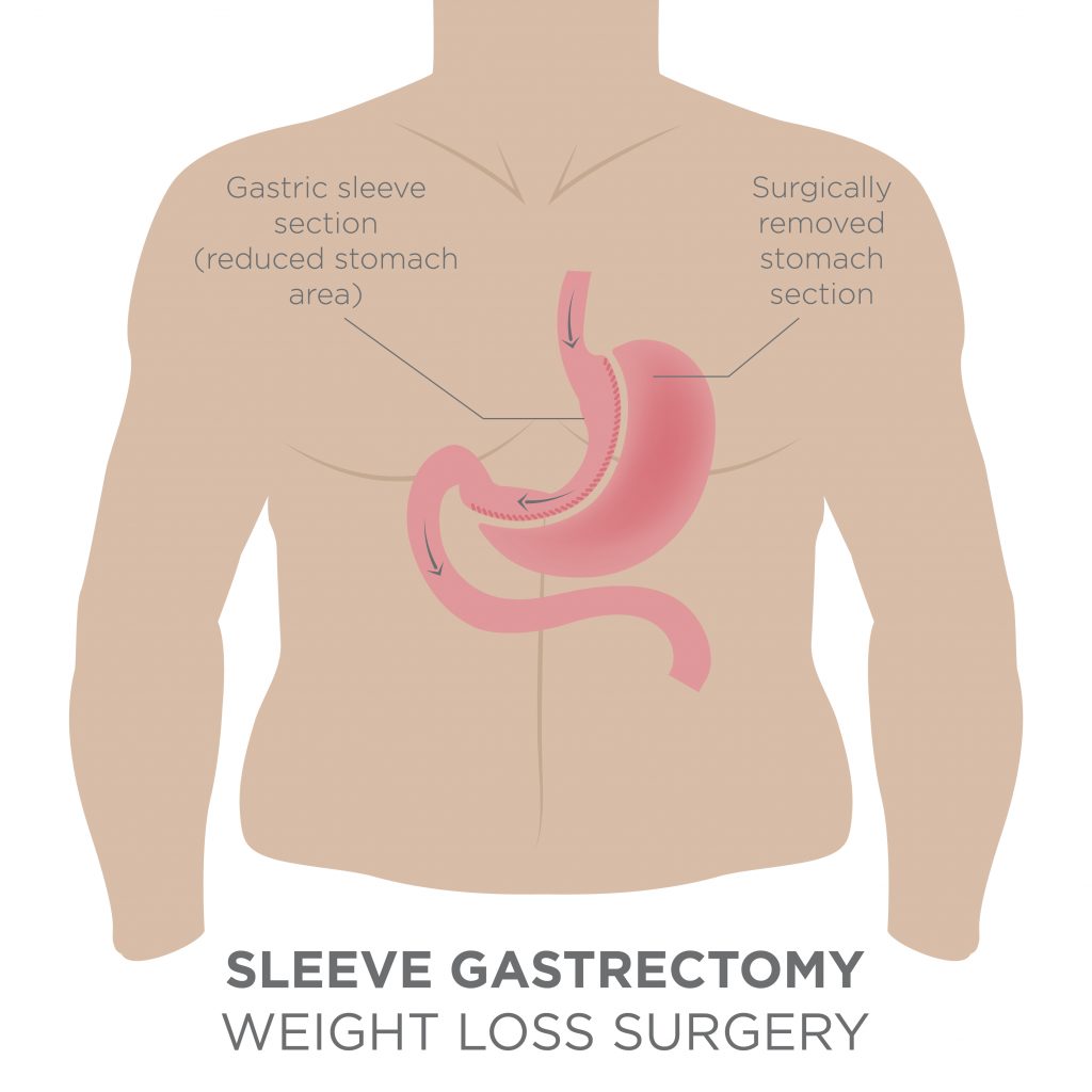 Gastric Bypass for Weight Loss